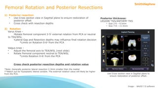Tka Alignment Rotation Ct 29578-1-v1-ri.knee-robotics-tka-mechanical-alignment-algorithm-for ...