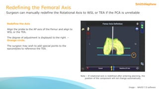 29578-1-v1-ri.knee-robotics-tka-mechanical-alignment-algorithm-for ...