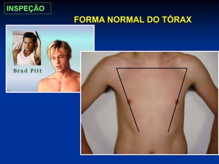 FORMA NORMAL DO TÓRAX
INSPEÇÃO
 