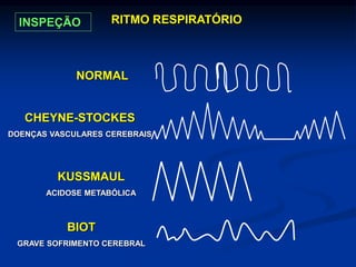 RITMO RESPIRATÓRIO
NORMAL
CHEYNE-STOCKES
DOENÇAS VASCULARES CEREBRAIS
KUSSMAUL
ACIDOSE METABÓLICA
BIOT
GRAVE SOFRIMENTO CEREBRAL
INSPEÇÃO
 