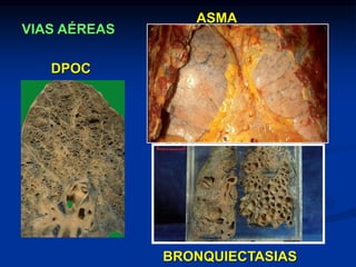 DPOC
ASMA
BRONQUIECTASIAS
VIAS AÉREAS
 
