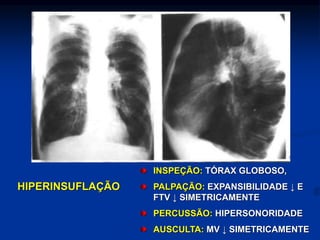 INSPEÇÃO: TÓRAX GLOBOSO,
PALPAÇÃO: EXPANSIBILIDADE ↓ E
FTV ↓ SIMETRICAMENTE
PERCUSSÃO: HIPERSONORIDADE
AUSCULTA: MV ↓ SIMETRICAMENTE
HIPERINSUFLAÇÃO
 