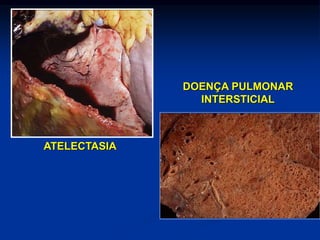 ATELECTASIA
DOENÇA PULMONAR
INTERSTICIAL
 