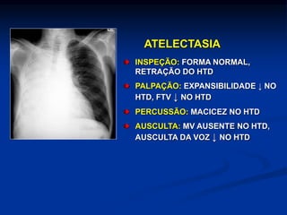 ATELECTASIA
INSPEÇÃO: FORMA NORMAL,
RETRAÇÃO DO HTD
PALPAÇÃO: EXPANSIBILIDADE ↓ NO
HTD, FTV ↓ NO HTD
PERCUSSÃO: MACICEZ NO HTD
AUSCULTA: MV AUSENTE NO HTD,
AUSCULTA DA VOZ ↓ NO HTD
 