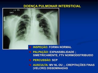DOENÇA PULMONAR INTERSTICIAL
INSPEÇÃO: FORMA NORMAL
PALPAÇÃO: EXPANSIBILIDADE ↓
SIMETRICAMENTE, FTV NORMODISTRIBUIDO
PERCUSSÃO: SCP
AUSCULTA: MV NL OU ↓, CREPITAÇÕES FINAS
(VELCRO) DISSEMINADAS
 