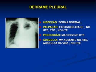 DERRAME PLEURAL
INSPEÇÃO: FORMA NORMAL,
PALPAÇÃO: EXPANSIBILIDADE ↓ NO
HTE, FTV ↓ NO HTE
PERCUSSÃO: MACICEZ NO HTE
AUSCULTA: MV AUSENTE NO HTE,
AUSCULTA DA VOZ ↓ NO HTE
 