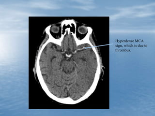 Hyperdense MCA
sign, which is due to
thrombus.
 