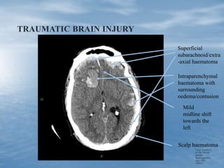 TRAUMATIC BRAIN INJURY
Case courtesy
of Dr Derek
Smith,
Radiopaedia.
org, rID:
36667
Superficial
subarachnoid/extra
-axial haematoma
Intraparenchymal
haematoma with
surrounding
oedema/contusion
Scalp haematoma
Mild
midline shift
towards the
left
 