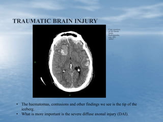 TRAUMATIC BRAIN INJURY
Case courtesy
of Dr Derek
Smth,
Radiopaedia.
org, rID:
36667
• The haematomas, contusions and other findings we see is the tip of the
iceberg.
• What is more important is the severe diffuse axonal injury (DAI).
 