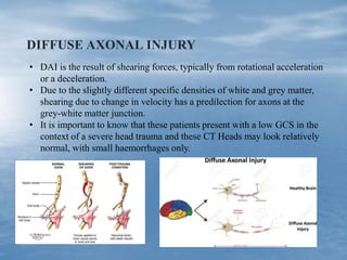 DIFFUSE AXONAL INJURY
• DAI is the result of shearing forces, typically from rotational acceleration
or a deceleration.
• Due to the slightly different specific densities of white and grey matter,
shearing due to change in velocity has a predilection for axons at the
grey-white matter junction.
• It is important to know that these patients present with a low GCS in the
context of a severe head trauma and these CT Heads may look relatively
normal, with small haemorrhages only.
 