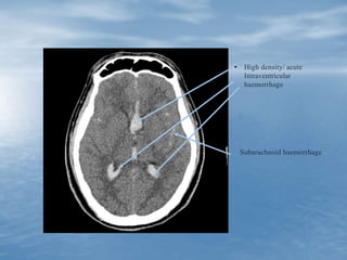 • High density/ acute
Intraventricular
haemorrhage
Subarachnoid haemorrhage
 