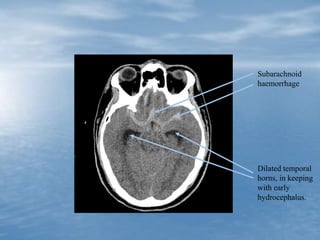Subarachnoid
haemorrhage
Dilated temporal
horns, in keeping
with early
hydrocephalus.
 