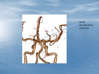 Small
saccular/berry
aneurysm
 