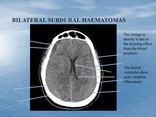 BILATERAL SUBDURAL HAEMATOMAS
The change in
density is due to
the layering effect
from the blood
products.
The lateral
ventricles show
near complete
effacement.
 