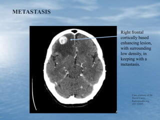 METASTASIS
Case courtesy of Dr
David Cuete,
Radiopaedia.org,
rID: 22895
Right frontal
cortically based
enhancing lesion,
with surrounding
low density, in
keeping with a
metastasis.
 