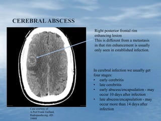 CEREBRAL ABSCESS
Case courtesy of
A.Prof Frank Gaillard,
Radiopaedia.org, rID:
19468
Right posterior frontal rim
enhancing lesion
This is different from a metastasis
in that rim enhancement is usually
only seen in established infection.
In cerebral infection we usually get
four stages:
• early cerebritis
• late cerebritis
• early abscess/encapsulation - may
occur 10 days after infection
• late abscess/encapsulation - may
occur more than 14 days after
infection
 