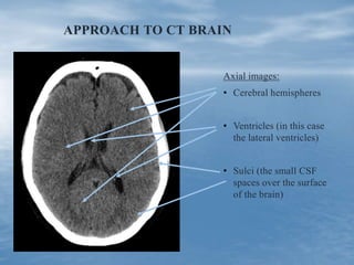 APPROACH TO CT BRAIN
Axial images:
• Cerebral hemispheres
• Ventricles (in this case
the lateral ventricles)
• Sulci (the small CSF
spaces over the surface
of the brain)
 