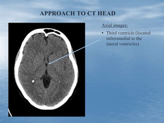 APPROACH TO CT HEAD
Axial images:
• Third ventricle (located
inferomedial to the
lateral ventricles)
 