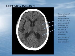 LEFT MCA INFARCT
• There is loss of
grey-white
differentiation
in the left MCA
territory, subtle
oedema with
effacement of
the sulci in
keeping with
infarction.
• No evidence of
haemorrhagic
transformation.
 