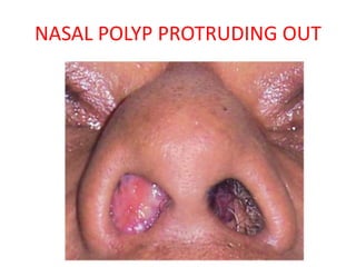 NASAL POLYP PROTRUDING OUT
 