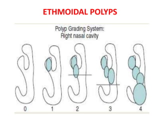 ETHMOIDAL POLYPS
 