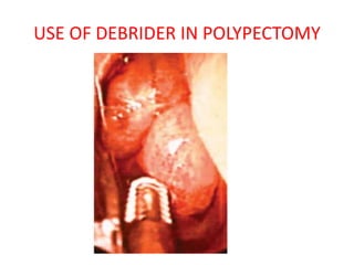 USE OF DEBRIDER IN POLYPECTOMY
 