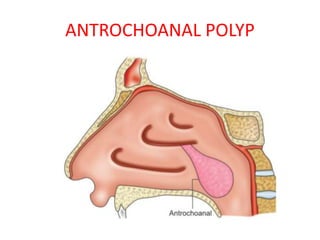 ANTROCHOANAL POLYP
 