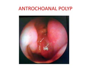 ANTROCHOANAL POLYP
 