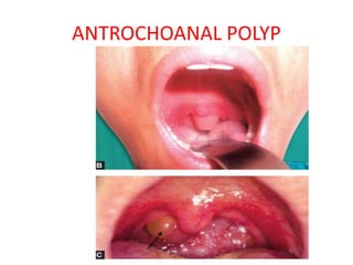 ANTROCHOANAL POLYP
 