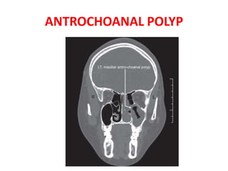 ANTROCHOANAL POLYP
 