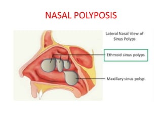 NASAL POLYPOSIS
 