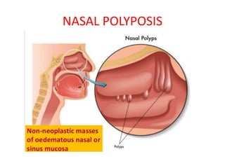 NASAL POLYPOSIS
 
