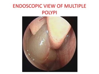 ENDOSCOPIC VIEW OF MULTIPLE
POLYPI
 