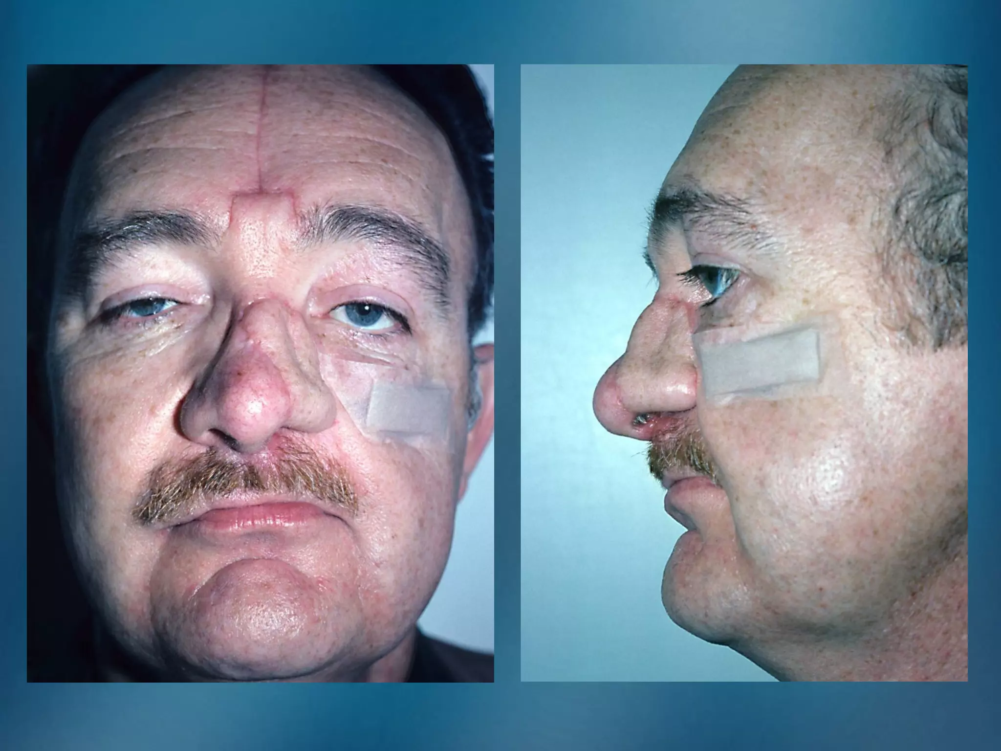 nasal reconstruction | PPT