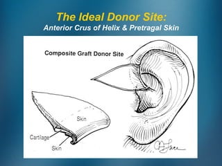 The Ideal Donor Site:
Anterior Crus of Helix & Pretragal Skin
 