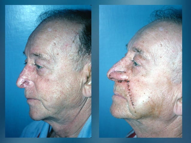 nasal reconstruction | PPT