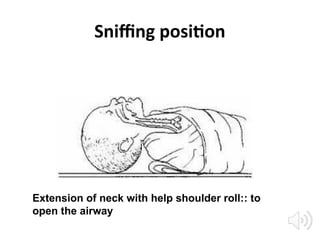 Sniffing position
Extension of neck with help shoulder roll:: to
open the airway
 