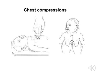 Chest compressions
 