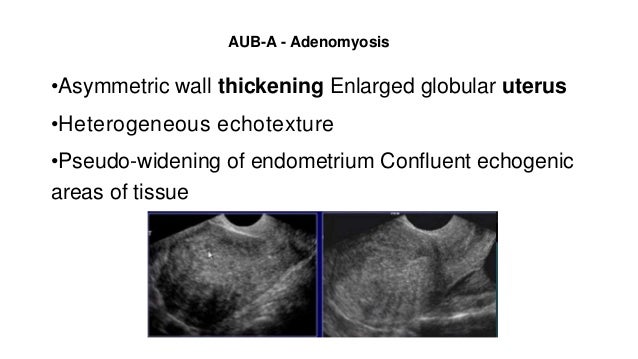 Aub Diagnosis And Evaluation By Dr Dipti Nabh Dr Sharda Jain