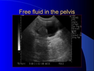 Free fluid in the pelvisFree fluid in the pelvis
 