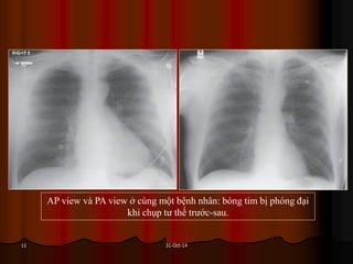 31-Oct-1411
AP view và PA view ở cùng một bệnh nhân: bóng tim bị phóng đại
khi chụp tư thế trước-sau.
 