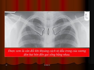 31-Oct-1413
Được xem là cân đối khi khoảng cách từ đầu trong của xương
đòn hai bên đến gai sống bằng nhau.
 