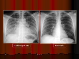 31-Oct-1418
Hít không đủ sâu Hít đủ sâu
 