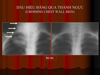 DẤU HIỆU BĂNG QUA THÀNH NGỰC
(CROSSING CHEST WALL SIGN)
Búi tóc
 