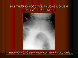 31 October 31, 2014
BAÁT THÖÔØNG HOAËC TOÅN THÖÔNG MOÂ MEÀM
ÑOÙNG VOÂI THAØNH NGÖÏC
HAÏCH VOÂI HOÙA ÔÛ BEÄNH NHAÂN COÙ TIEÀN CAÊN LAO PHOÅI
 
