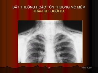 32 October 31, 2014
BAÁT THÖÔØNG HOAËC TOÅN THÖÔNG MOÂ MEÀM
TRAØN KHÍ DÖÔÙI DA
 