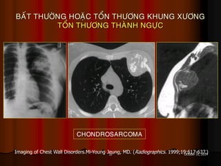 33 October 31, 2014
BAÁT THÖÔØNG HOAËC TOÅN THÖÔNG KHUNG XÖÔNG
TOÅN THÖÔNG THAØNH NGÖÏC
Imaging of Chest Wall Disorders.Mi-Young Jeung, MD. (Radiographics. 1999;19:617-637.)
CHONDROSARCOMA
 