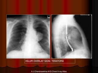 A.J.Chandrasekhar,M.D.Chest X-ray Atlas.
HILUM OVERLAY SIGN: TERATOMA
 