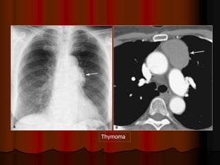 Thymoma
 