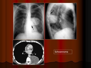Schwannoma
 